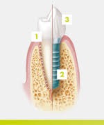 1 – Dente natural  2 – Implante dentário  3 – Coroa dentária