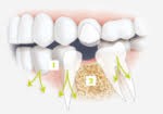 Efeito de dentes ausentes no maxilar